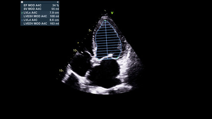 Image of the heart in gray-scale mode during transesophageal ultrasound.