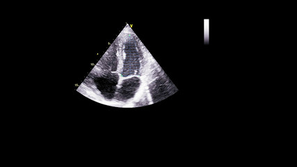 Image of the heart in gray-scale mode during transesophageal ultrasound.