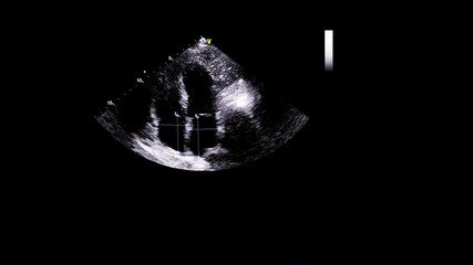 Obraz premium Image of the heart in gray-scale mode during transesophageal ultrasound.