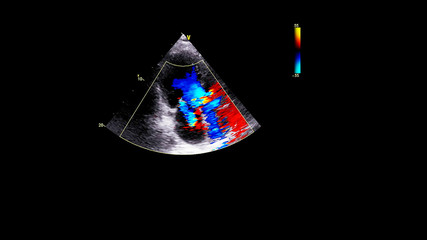 Image of the heart during transesophageal ultrasound with Doppler mode.