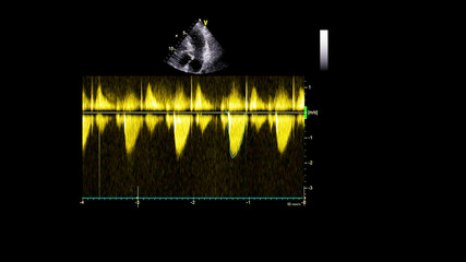Image of the heart in gray-scale mode during transesophageal ultrasound.