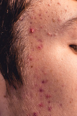 Fototapeta premium Young face with acne