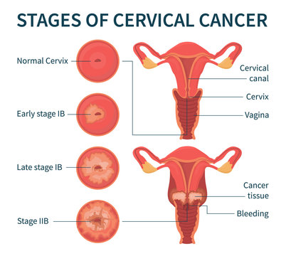 Flat vector illustration of stages of cervical cancer including normal, early, late stage IB and stage IIB. The scheme shows cervical canal, cervix, vagina, cancer tissue and bleeding.