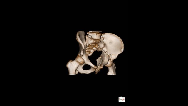 CT Scan pelvis 3D render Impression:Transverse fracture of acetabulum. Fracture Lt ishiopubic rami.Posterosuperior dislocation of Left femoral head. Medical technology concept.