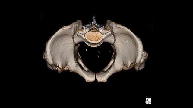 CT Scan pelvis and Both hip joint space and articular surface appear normal.No focal mass in pelvic cavity.
Impression:Myositis ossifican at muscle superolateral to Right acetabulum.