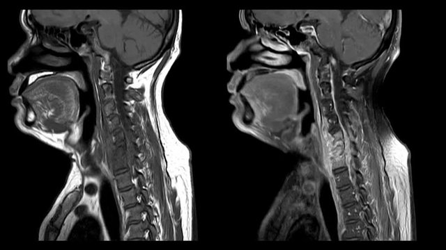 Magnetic resonance imaging(MRI) Cervical spine rule out Herniated disc pulposus : HNP or Tuberculosis of Spine.Medical footage concept.