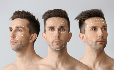 Collage of handsome young man on grey background. Plastic surgery concept