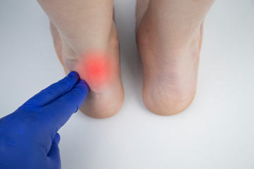 An orthopedic doctor examines a woman's leg. Achilles tendon and ankle diseases. Inflammation of...