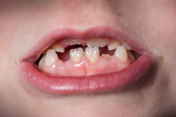 Kindergebiss mit Zahnlücken