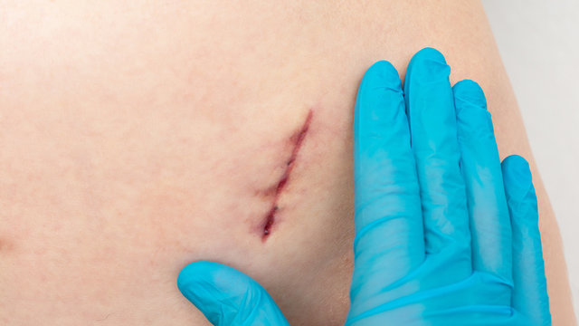 Doctor shows a dark scar from the Appendix, doctor's hand, close-up. Concept of health, 16:9
