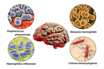 Etiology of bacterial meningitis