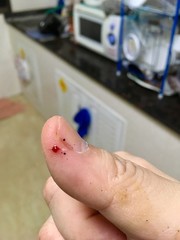 Bleeding in the thumb because of a knife that cuts the finger
The accident happened in the kitchen.