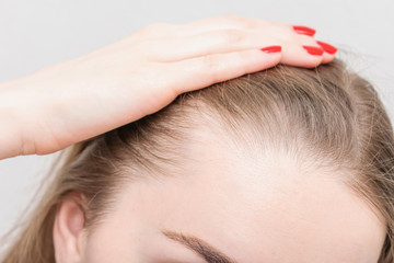 Naklejka premium Girl shows on hair, close up. Concept of hair loss treatment