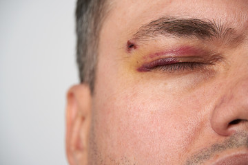 Obraz premium close view of a black eye, man's face with a hematoma