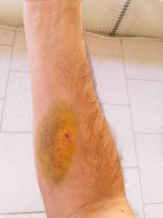 Big bruise on a man's arm with a small wound at the center of it.