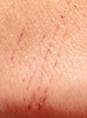 A wound on the skin of a person as a background.