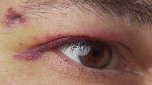 close view of a black eye, man's face with a hematoma