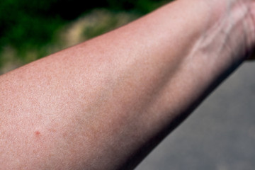Tick bite on the arm of a woman. Little red dot, skin redness, wound and consequences right after...