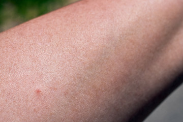Tick bite on the arm of a woman. Little red dot, skin redness, wound and consequences right after the insect bite. Documented on a sunny spring day in Bavaria, Germany - Europe.