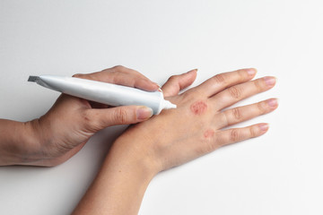 Girl smears eczema cream on her hands isolate on white background. Skin diseases, dermatitis,...