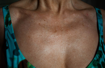 Piel del escote con arrugas y manchas por el foto envejecimiento prematuro de la piel por tomar el...