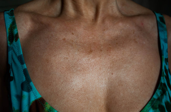 Piel del escote con arrugas y manchas por el foto envejecimiento prematuro de la piel por tomar el sol