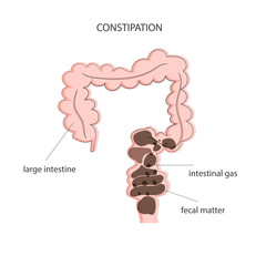 Fecal obstruction and gas accumulation in the colon. Medical poster constipation. Vector illustration