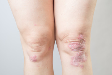 Acute psoriasis on the knees is an autoimmune incurable dermatological skin disease. Large red, inflamed, flaky rash on the knees. Joints affected by psoriatic arthritis.Close up - obrazy, fototapety, plakaty