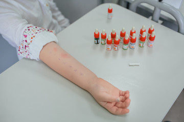 Reaction for Skin Prick Allergy Testing