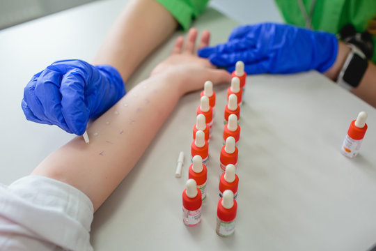 Cropped view of doctor examining allergic reaction with pipette