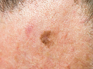 Fototapeta premium Lentigo maligna (melanoma in situ) on forehead of 64 year old male