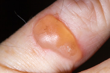 Blisters caused by cryotherapy fro solar keratosis on skin of 64 year old Caucasian male.