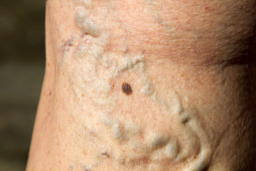 Fototapeta premium Varicose veins on the back of the leg of 64 year old female.