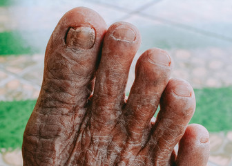 Foot and foot disease