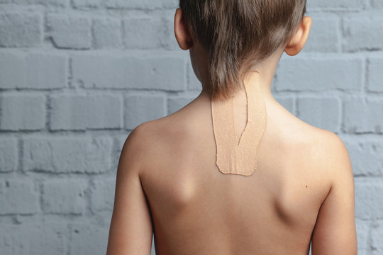 Child athlete with teips on his back. Treatment of spine, back problems, scoliosis. 