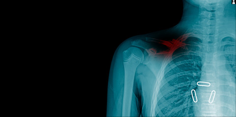 fracture clavicle