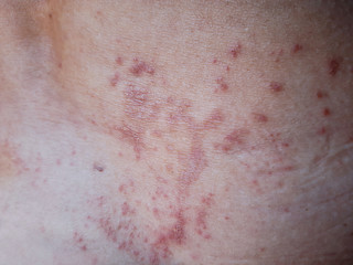 Fototapeta premium Skin disease prickly heat rash or miliaria on back skin of asian woman. Healthcare skin cause for outdoor work in sunny with hot weather and have sweat. Dermatologist and treatment medication concept.