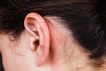 Dandruff in the hair and behind the ears of a young woman. Dry scalp skin itches