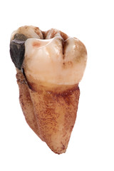 single extracted molar tooth with caries decay and filling isolated on white Background. Macro Photography