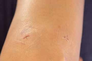 Fototapeta premium Post-surgery knee with stitches