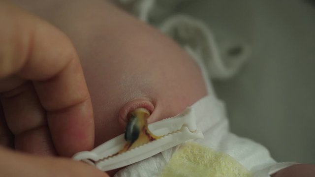newborn umbilical stump, umbilical cord clip clamp