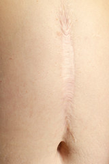 large scar on the stomach that has split