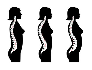 Kyphosis, lordosis flat vector illustration.