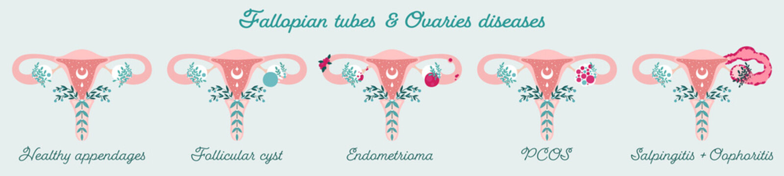 Women health - Fallopian tubes and Ovaries disorders - PCOS, endometrioma e.t.c. Gynecological diseases - Patient-friendly infographic. Uterus in flowers diagram - Isolated anatomical schemes
