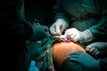 suture wound of CA sacroma at fumur with radivac drain. Best health care managment in hospital