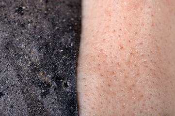 Area of problem skin. Exfoliated cosmetic mask with charcoal that removed acne and cleaned the skin.