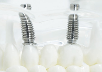 Screwed dental implants in the jaw. Concept of modern procedure in dentistry, dental implants, background