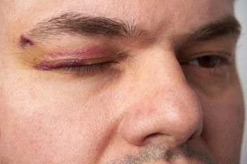 Fototapeta premium close view of a black eye, man's face with a hematoma