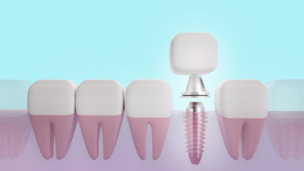 Dental implant 3d rendering image for medical content..