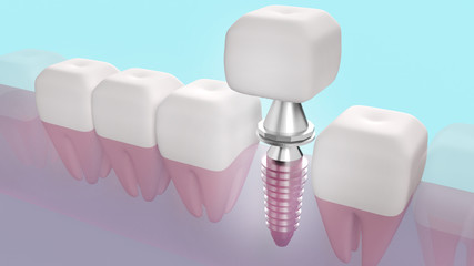 Dental implant 3d rendering image for medical content..